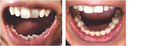 Harmonieschiene Teltow, Berlin | Zahnarztpraxis Engel